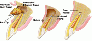 Surgical Root canal treatment by Dr. Steven Cohen Endodontist in Mississauga GTA